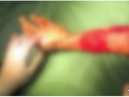 驚險(xiǎn)！26歲小伙被電梯門夾住，手臂完全離斷，8小時(shí)手術(shù)成功再植！